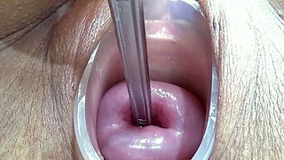 German Extreme Cervix Fucking